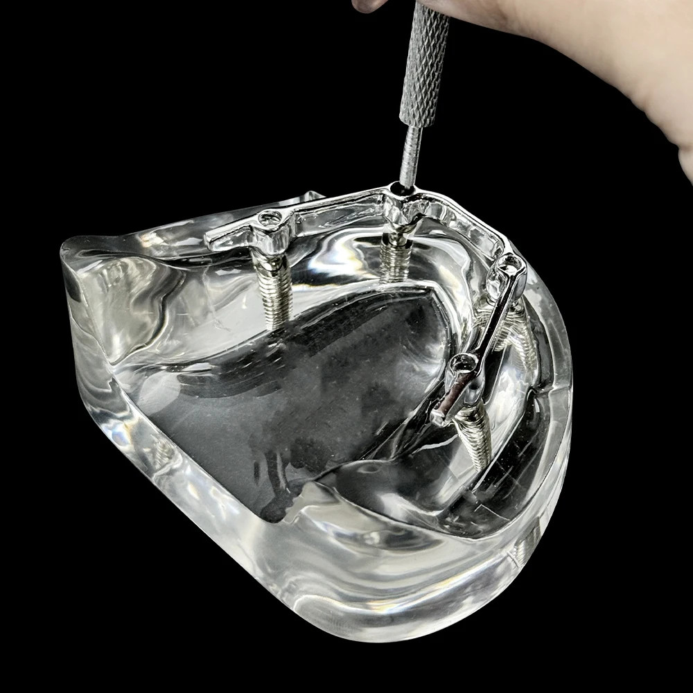 Dental Lower Jaw Implant Model Removable 4Implants Overdenture Restoration Model