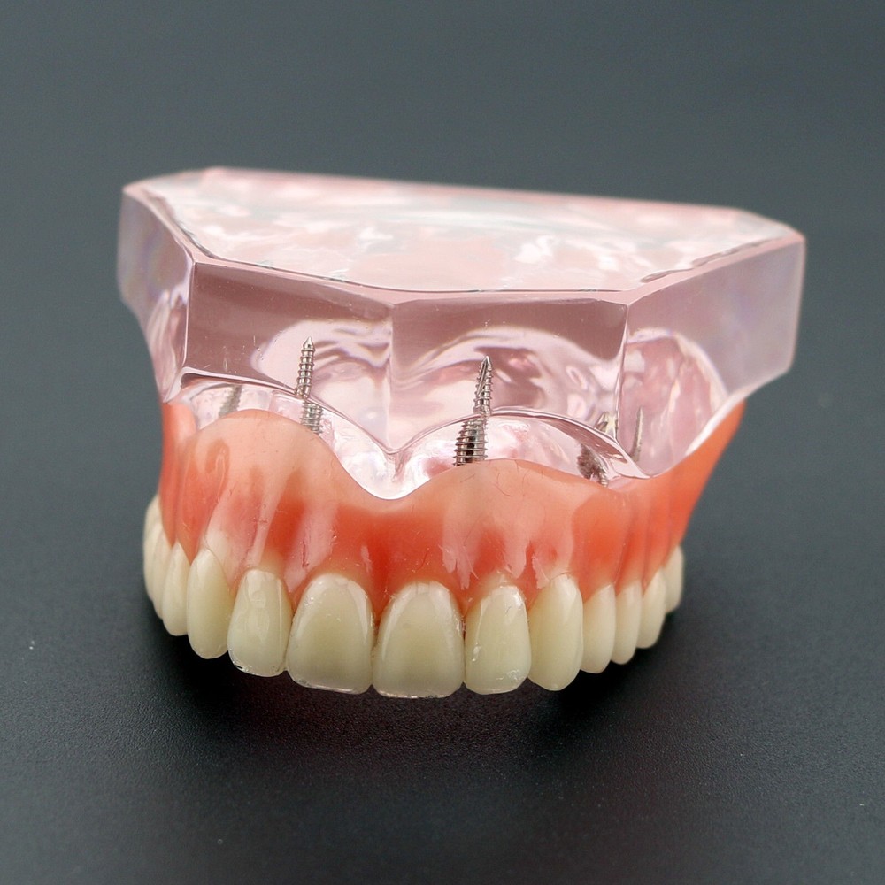 Dental Implant Overdenture Upper Superior Model Precision 4 Maxillary