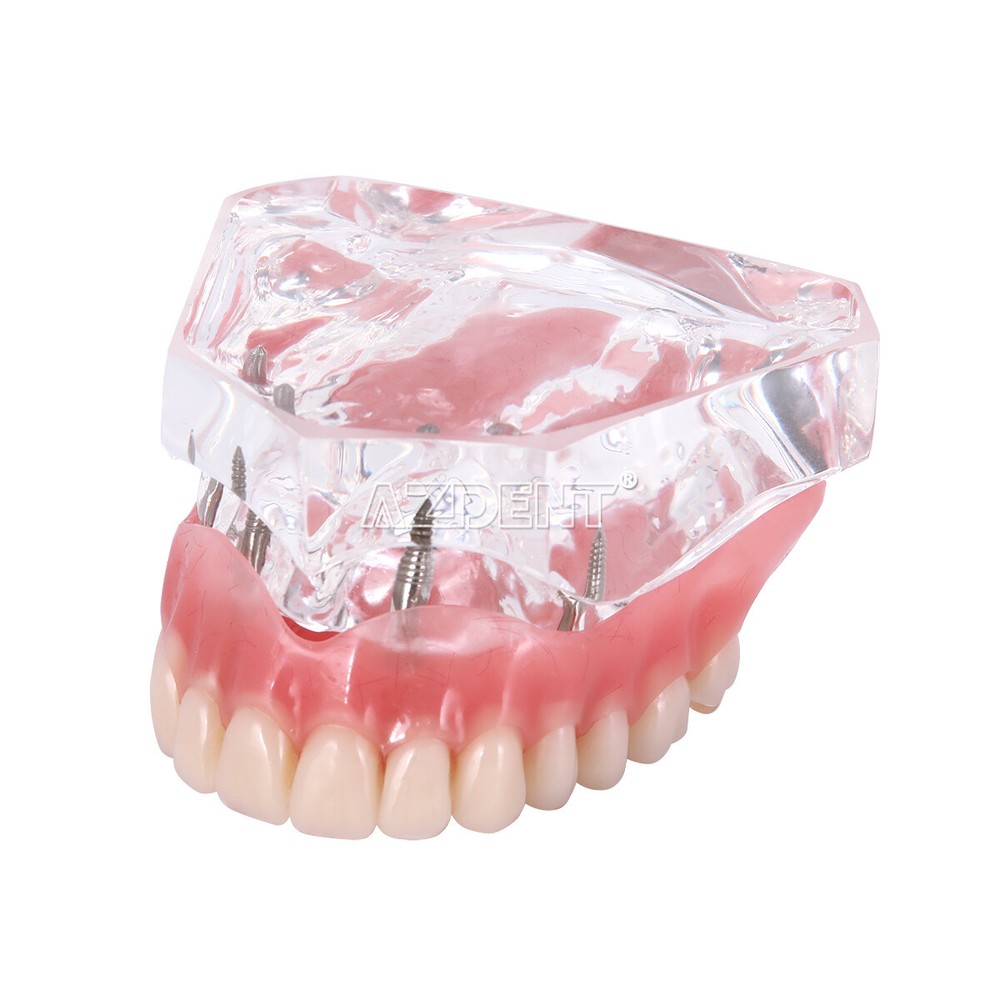 Dental Implant Teach Study Model Demo Overdenture Typodont 4Implants Upper Lower