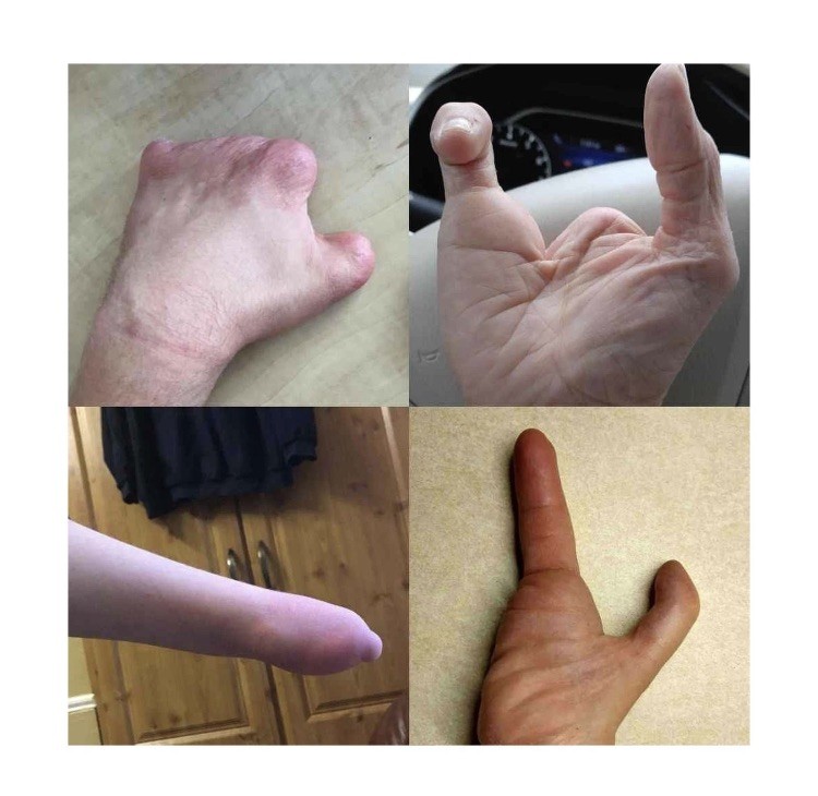 Active Hands Limb Difference Gripping Aid | Small Size For Left Hand | Black!