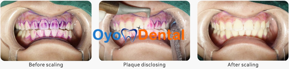 Woodpecker AP-A Dental Air Flow Polisher Polishing (Supragingival & subgingival)