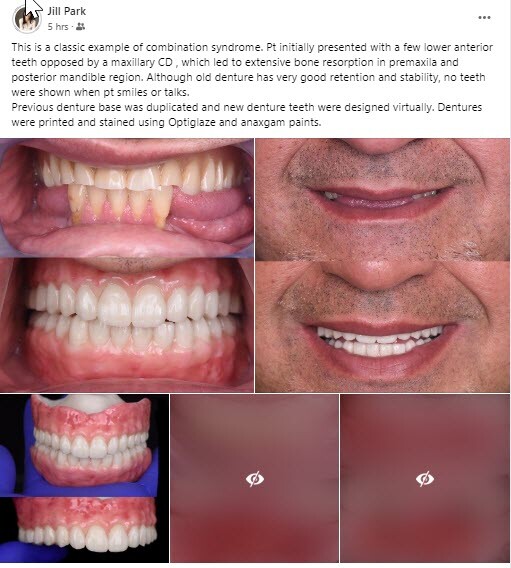 DLP SLA LCD 3d printer temporary teeth resin ..