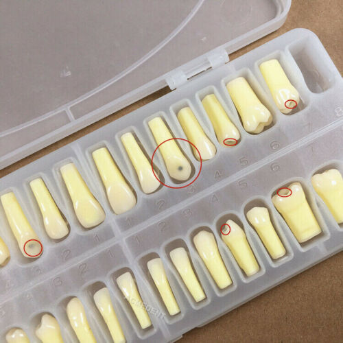 Dental Caries Remove Teeth Decayed Removing Practise Model Dentist Student Exam