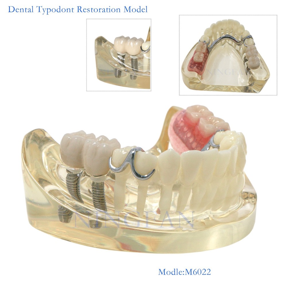 Dental Typodont partial denture Model RPD Demo Retainer WIth 2 Implants