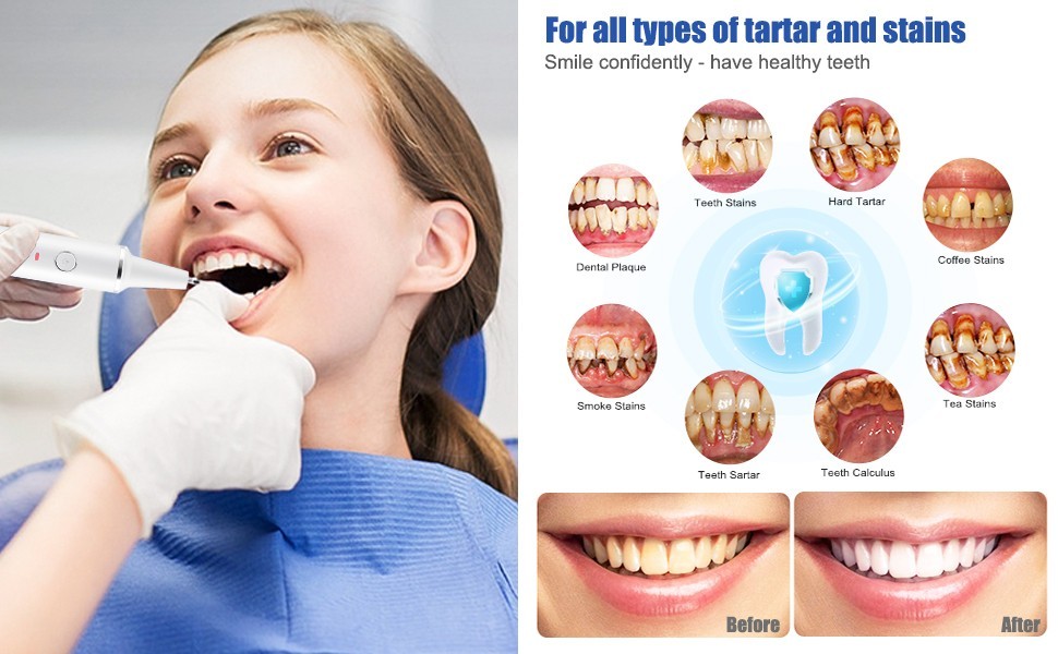 Electric Ultrasonic Dental Calculus Tooth Cleaner LED Scaler Plaque Remover Tool