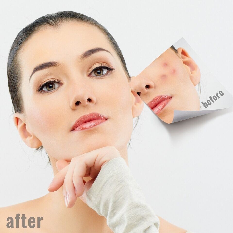 Dolabey Blackhead Pimples Acne Blemish Comedone Extractor Solid Stick 5 Tool Set