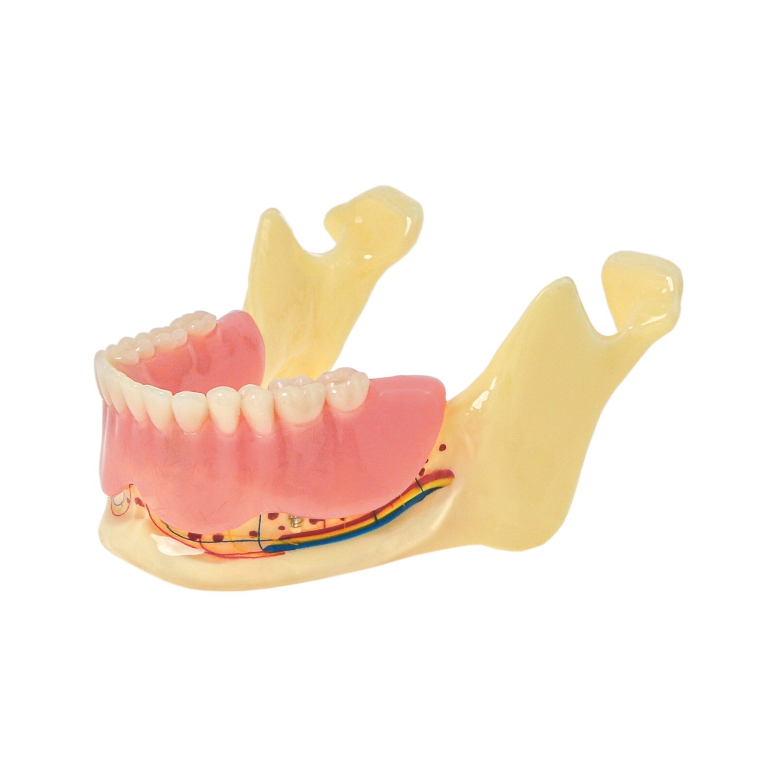 Dental Implant Typodont Teeth Restoration Model Series Overdenture Practice Demo