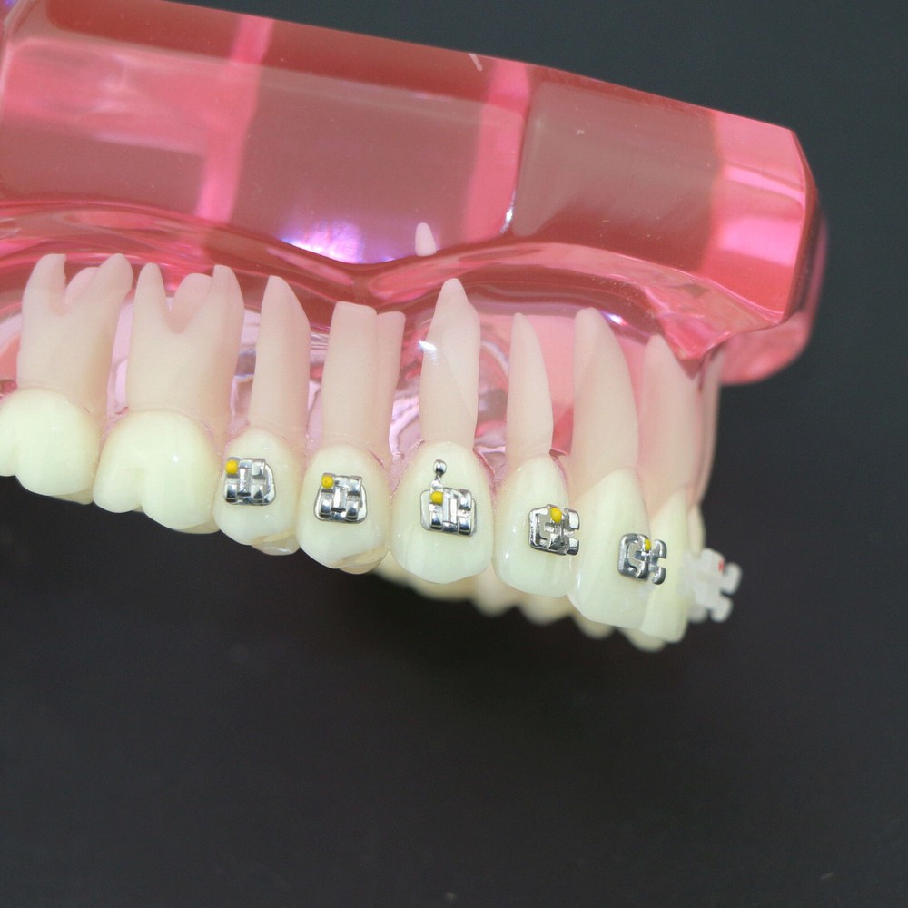 Dental Orthodontic Demonstration Ceramic and Metal Bracket Study Typodont Model