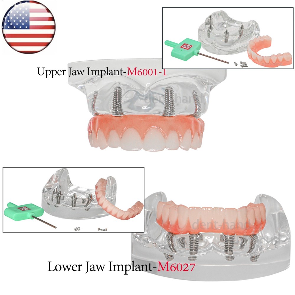 US Dental Overdenture Upper/Lower 4 Implants Demo Teeth Restoration Model