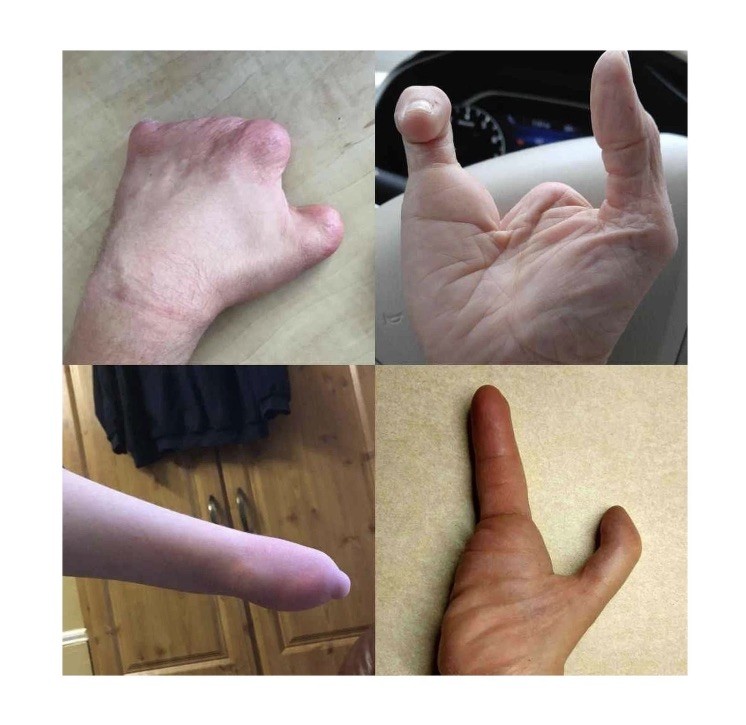 Active Hands Limb Difference Gripping Aid | Standard Size For Right Hand | Black