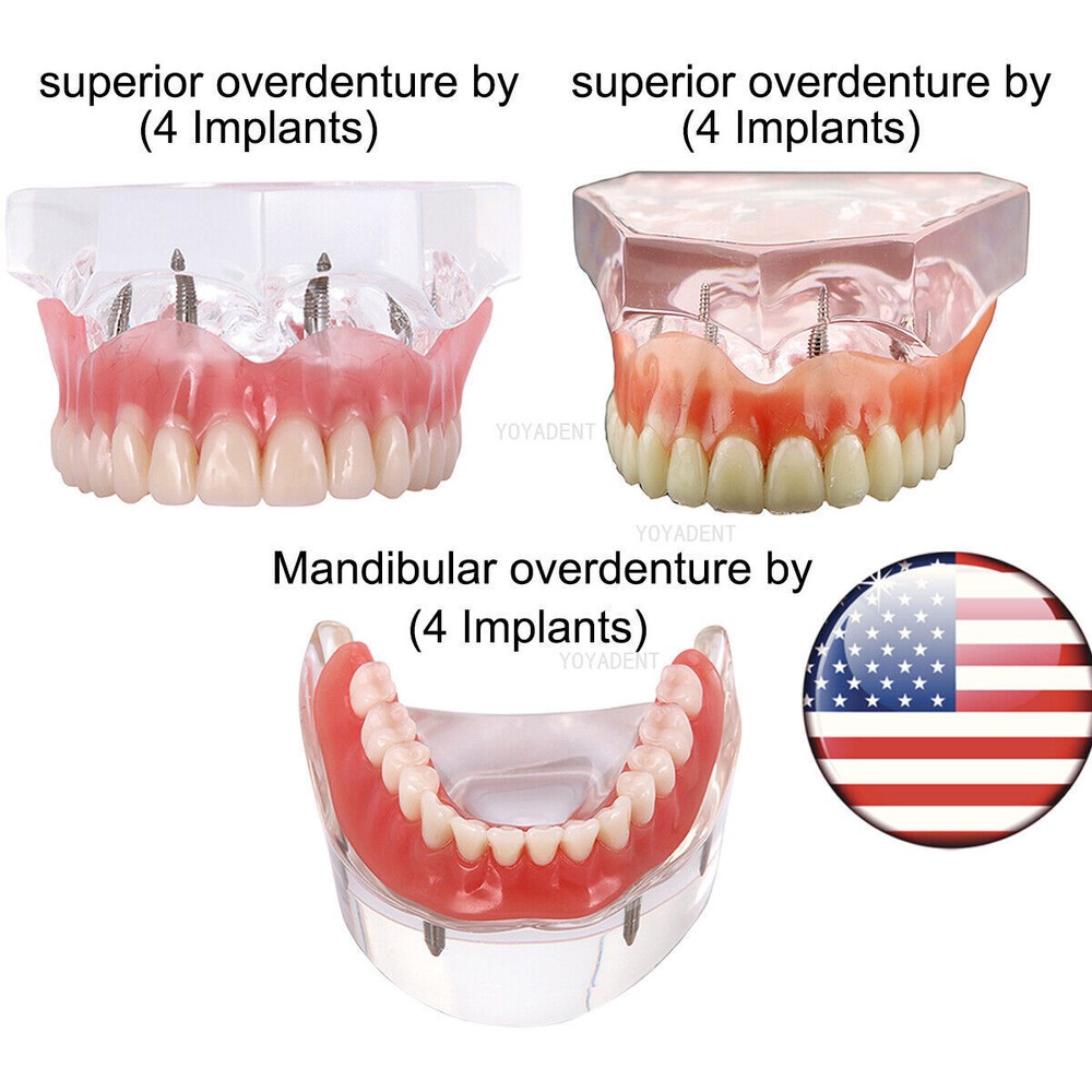 Dental Model 4 Implants superior/Mandibular Removable Overdenture Teeth Model