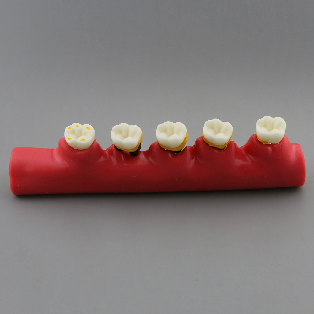 Dental Study Teaching Model Periodontal Disease Assort Teeth Dentoform Typodont