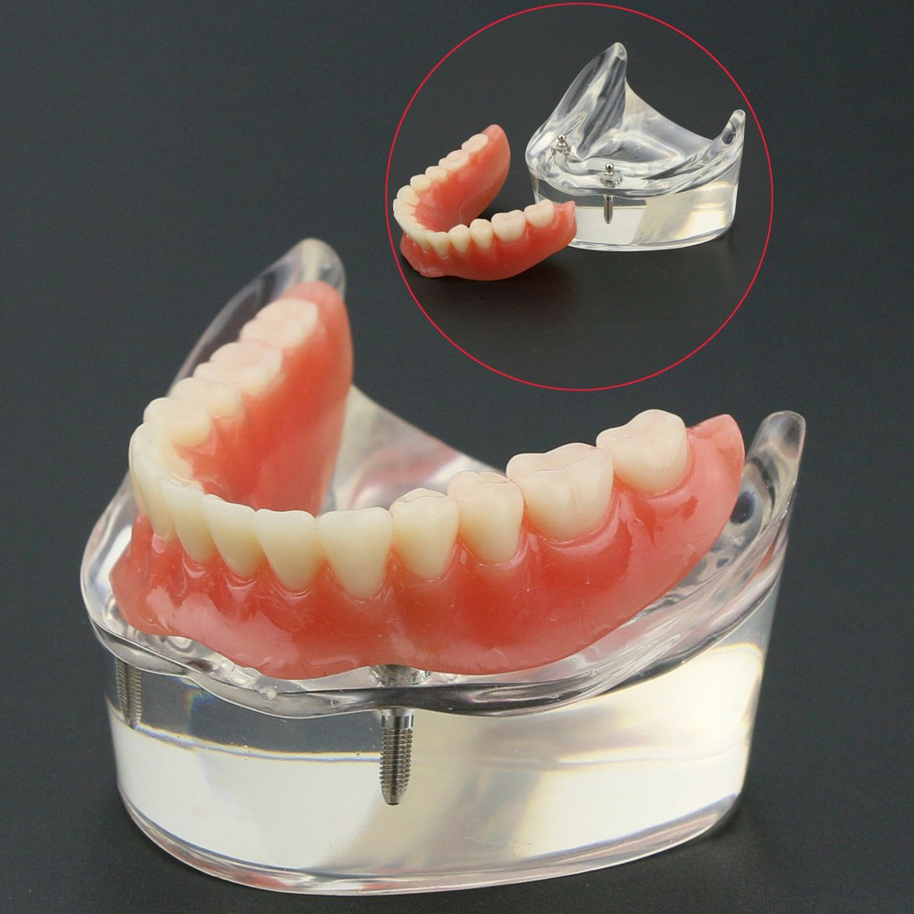 Dental Overdenture Tooth Restroration Model Inferior Teeth 2 Implants #6002 Demo