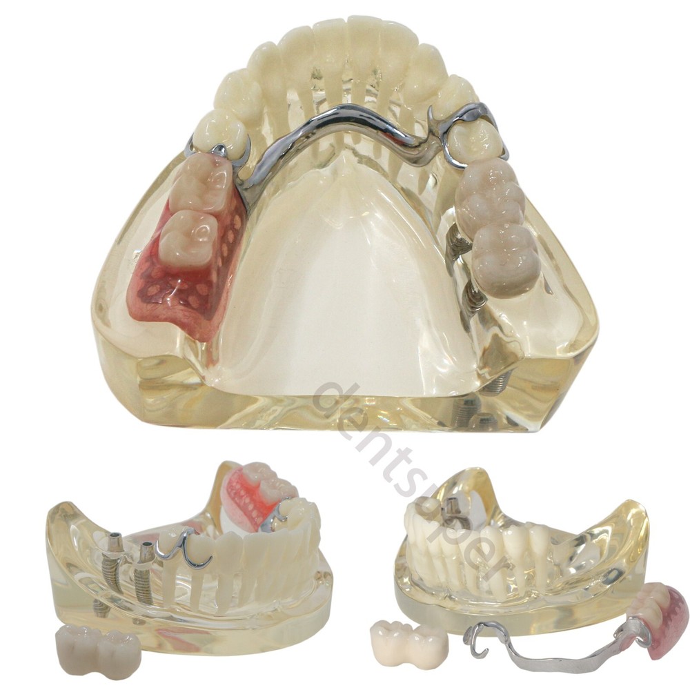 Typodont Restoration Dental Teeth Model With Partial Denture Demo 2 Implants