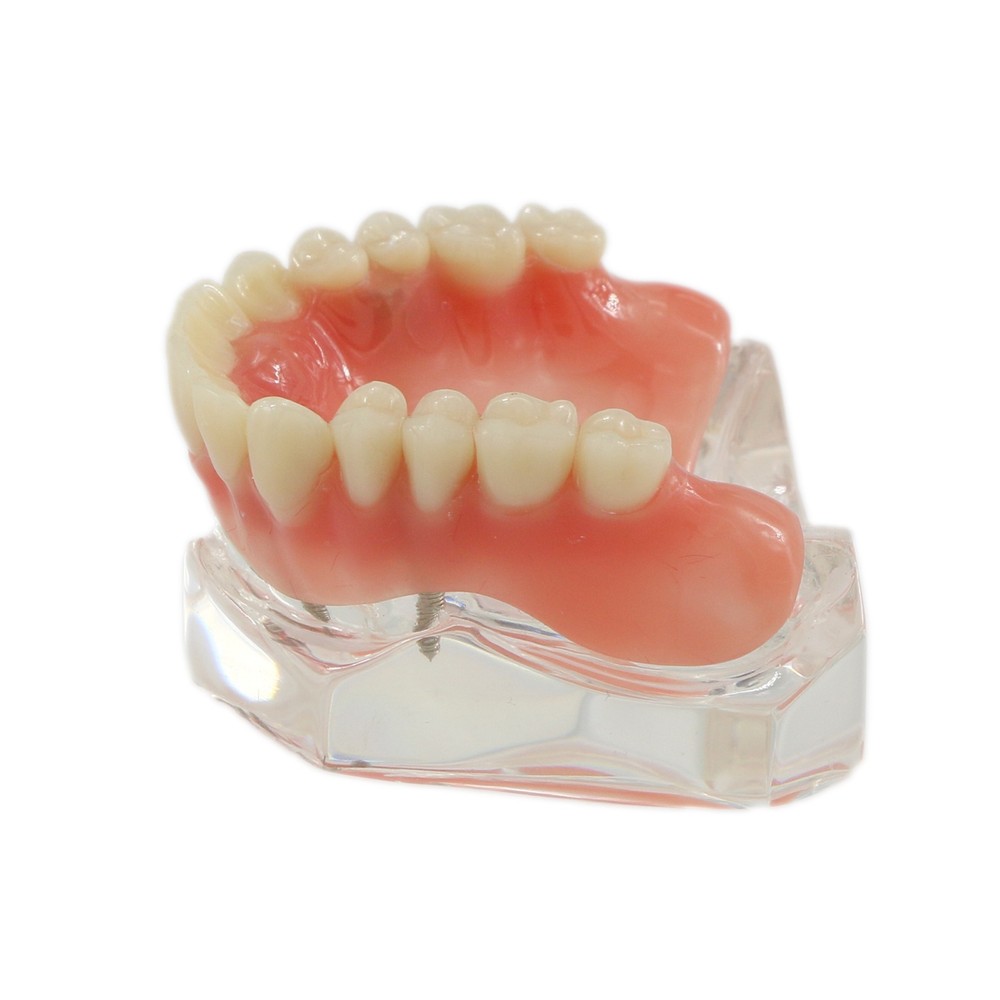 Dental Teeth Model Overdenture Removable Teeth Upper/Lower Jaw 4 Implants Model