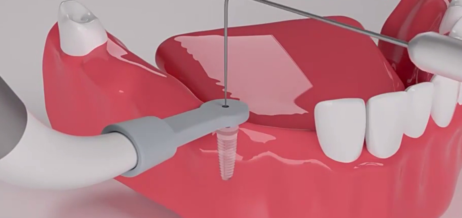 Dental Implant Locator Detector 360°Rotating Spotter Sensor+3Pcs Sensor USA