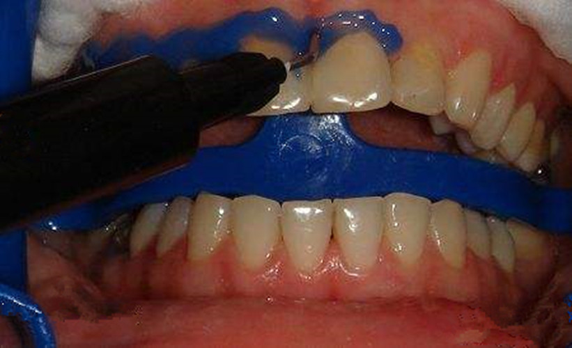 5PC*3ml Dental Gingival Barrier Gel Tooth Dam Barrier Gel Gum Protector Syringe