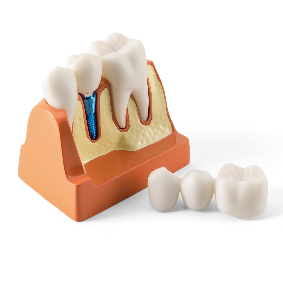 4 Times Dental Teeth Removable Model Implant Teaching Learning Tool Analysis