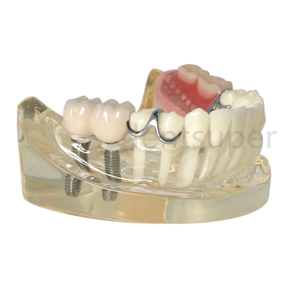 Typodont Restoration Dental Teeth Model With Partial Denture Demo 2 Implants