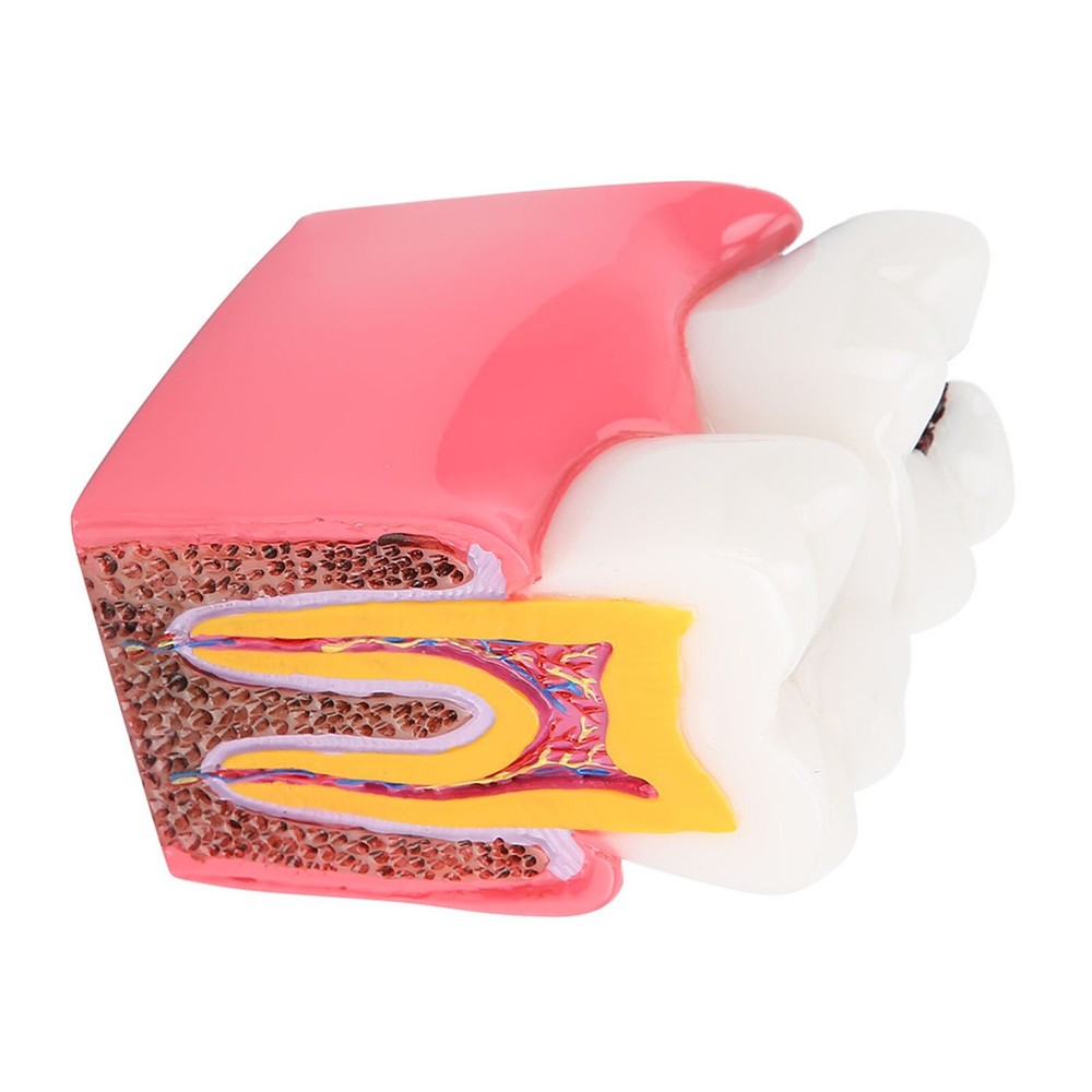 Caries Comparison Study Models Dentist Dental Anatomy Education Teeth Model