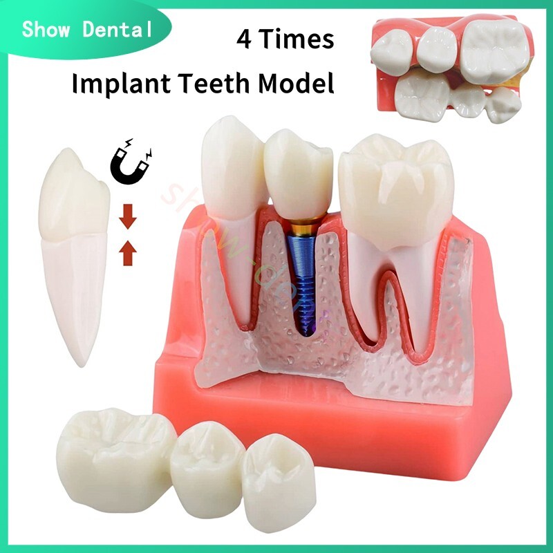 Dental Implant Analysis Removable Crown Teeth Model  Analysis  Study Model