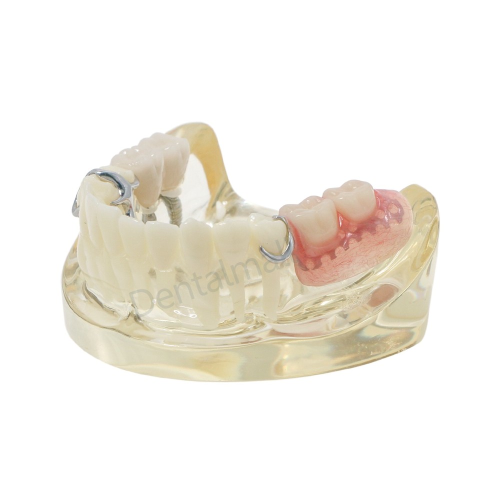 Dental Typodont Restoration Model With 2 Implants Partial Denture Demo