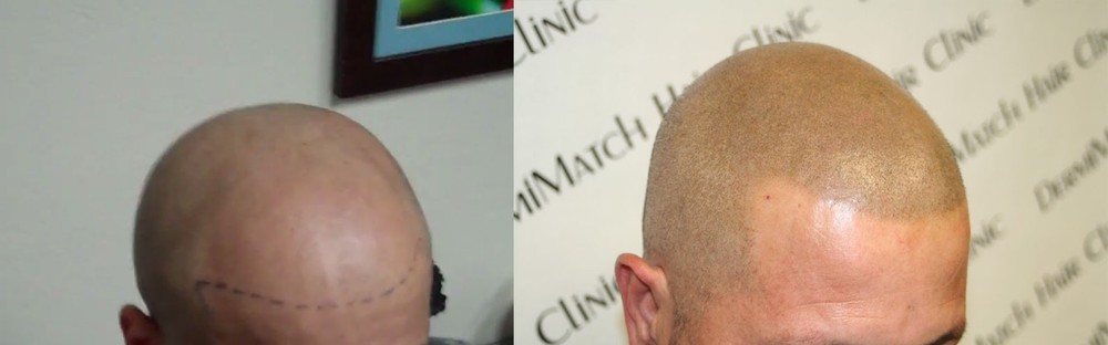 HD Scalp Micropigmentation Kit by DermiMatch