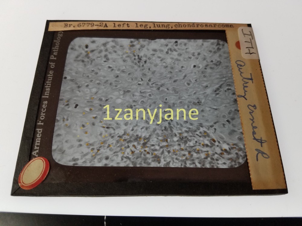 ITH HISTORIC Magic Lantern GLASS Slide A LEFT LEG LUNG CHONDROSARCOMA