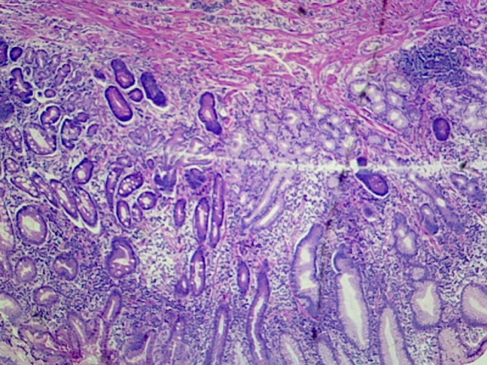Gastric Ulcer (Human); Section; H&E Stain