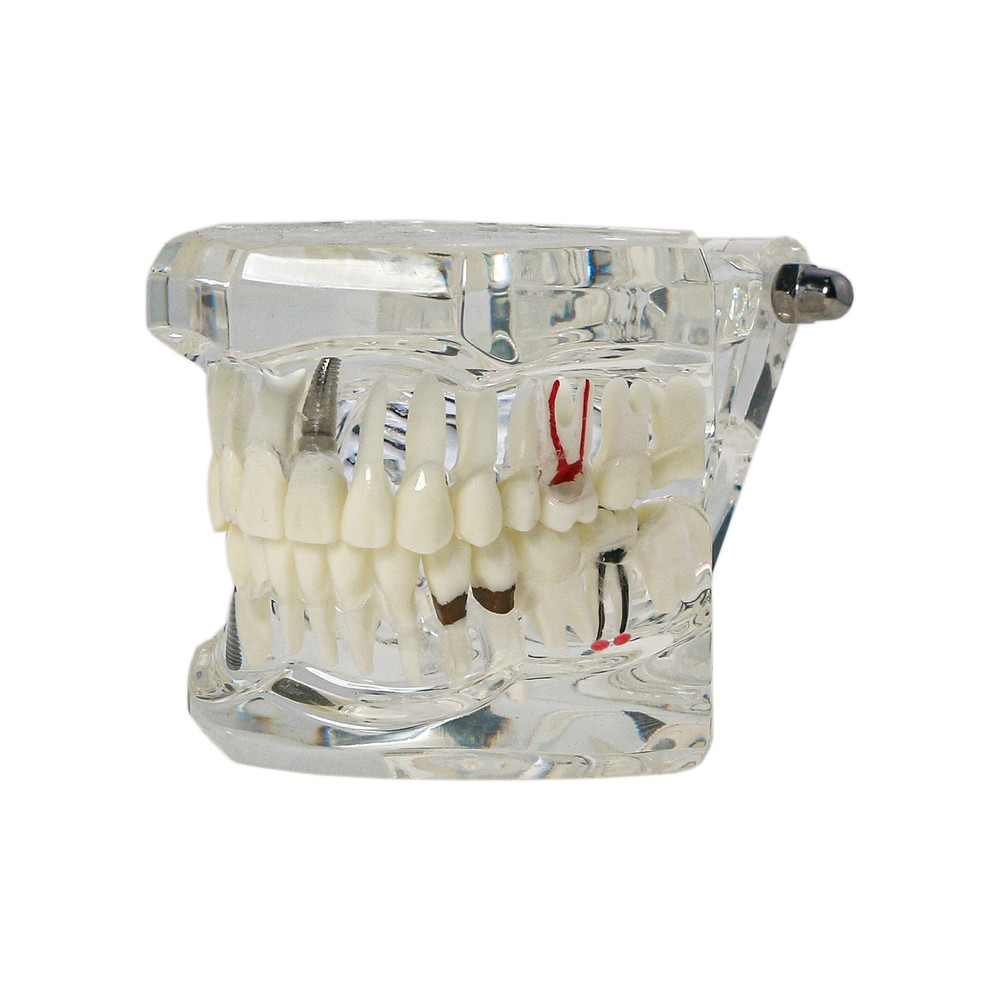 Dental Implant Disease Study Teaching Teeth Model Restoration Bridge Tooth Analy