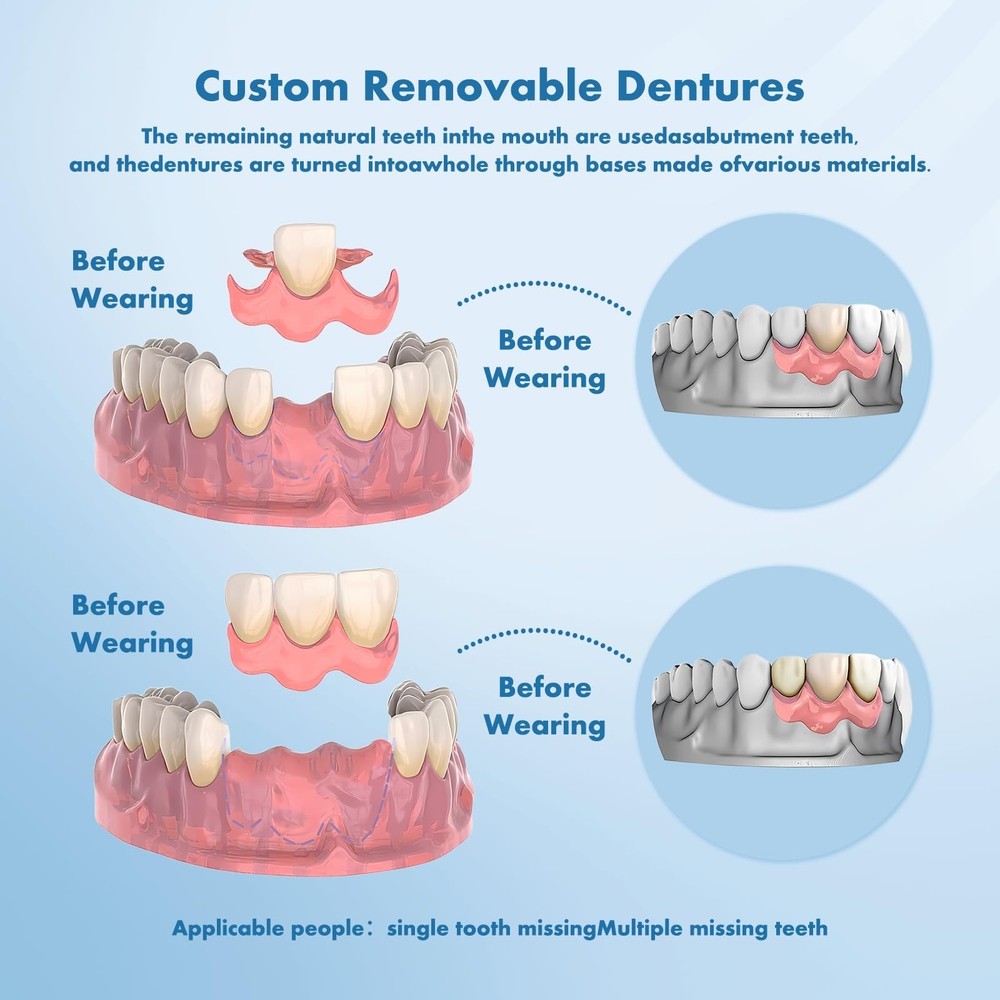 Custom Removable Dentures – Personalized Partial Denture Set for Tooth Rep