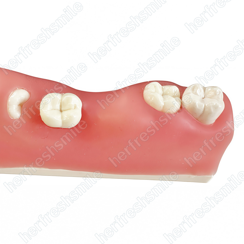 Dental Impacted Tooth Model Wisdom Unerupted Tooth Extraction Practice Training