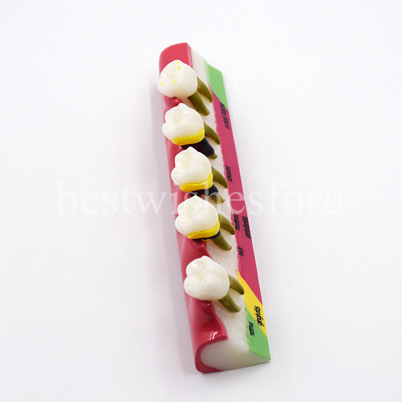Dental Periodontal Disease Assort Developing Demonstration Teeth Study Model