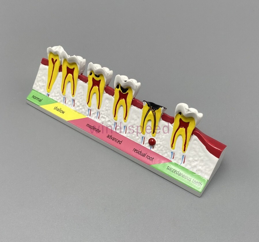 New Dental Study Teaching Models Caries Disease Assort Teeth Dentoform Model