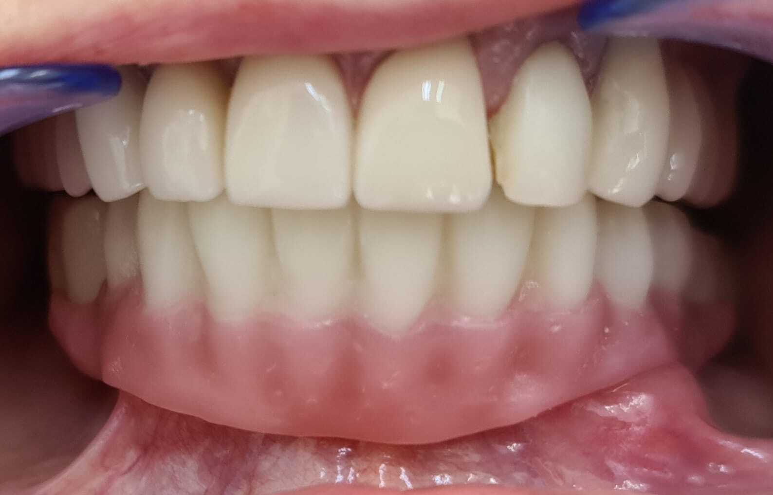 DLP SLA LCD 3d printer ALL ON X resin - for all on x cases, bridges,arcs, hybrid