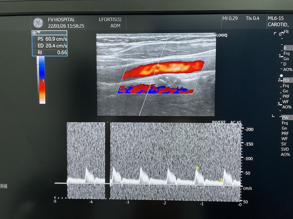GE Ultrasound probe Linear ML6-15D