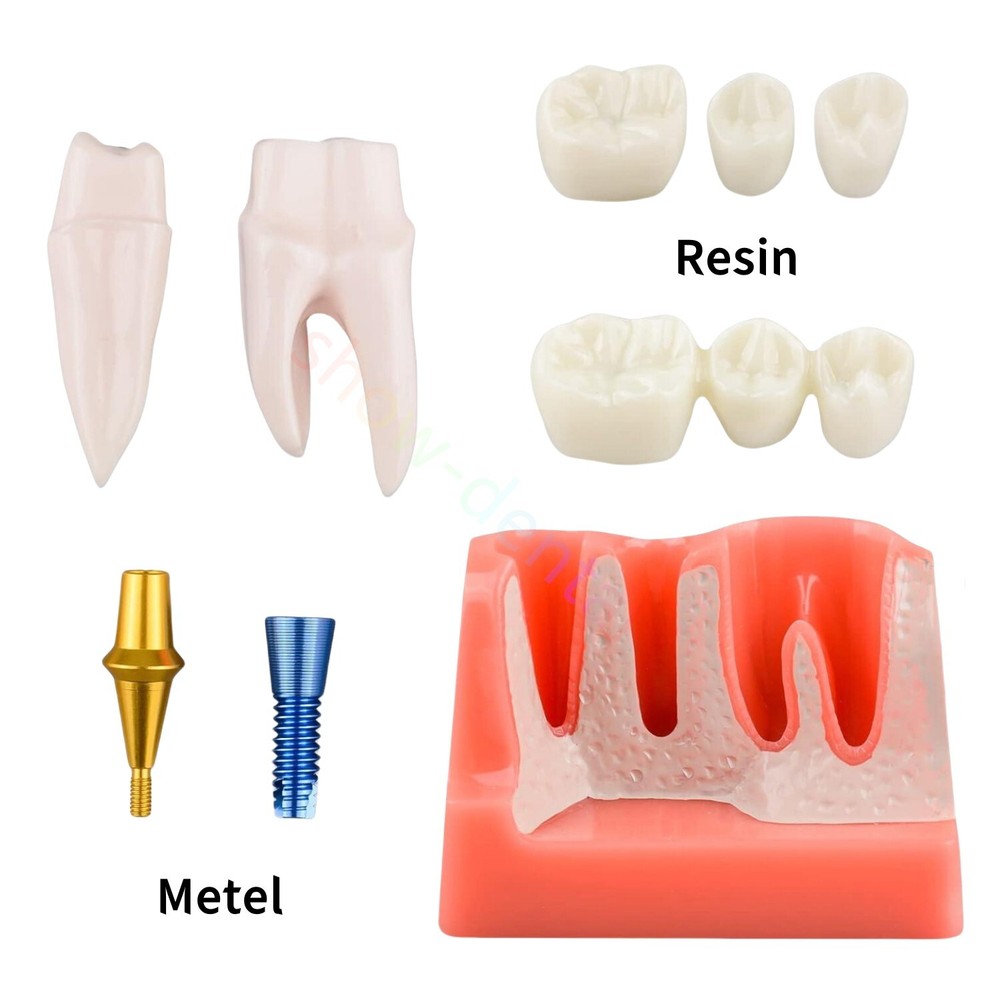 Dental Implant Analysis Removable Crown Teeth Model Analysis Study Model
