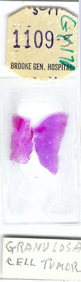 Human Granulosa Cell Tumor Pathology Microscope Slide