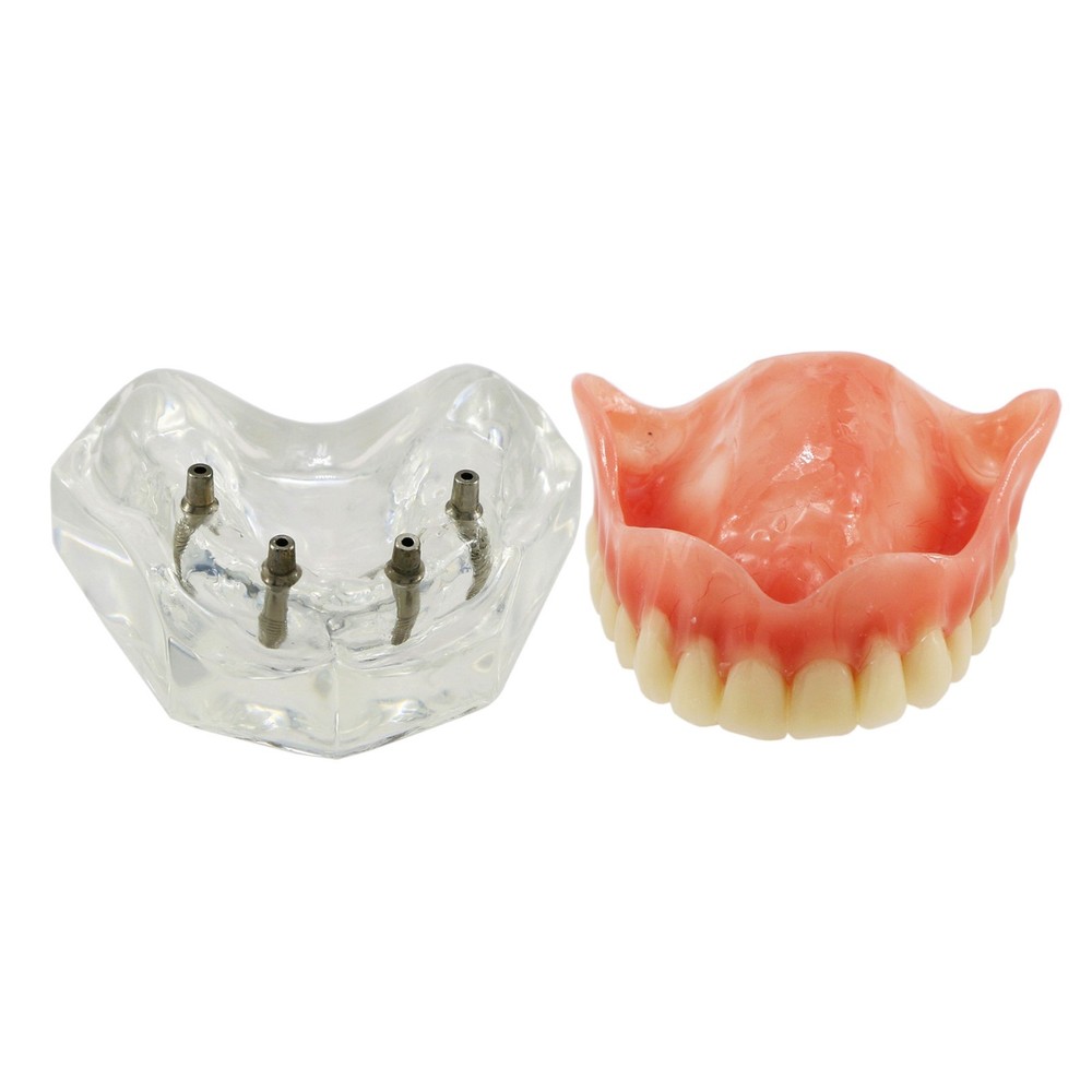 Dental Teeth Model Overdenture Removable Teeth Upper/Lower Jaw 4 Implants Model