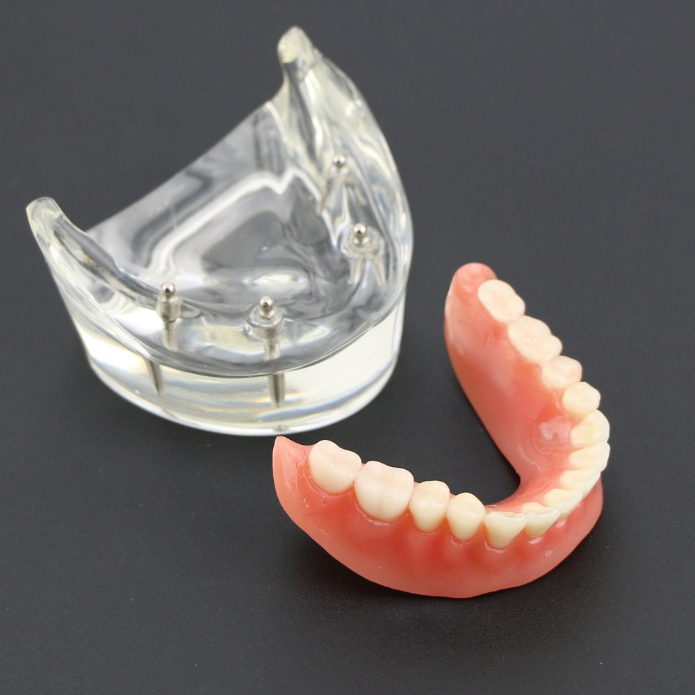 Dental Typodont Lower Teeth Demo Study Model Overdenture Inferior 4 Implants