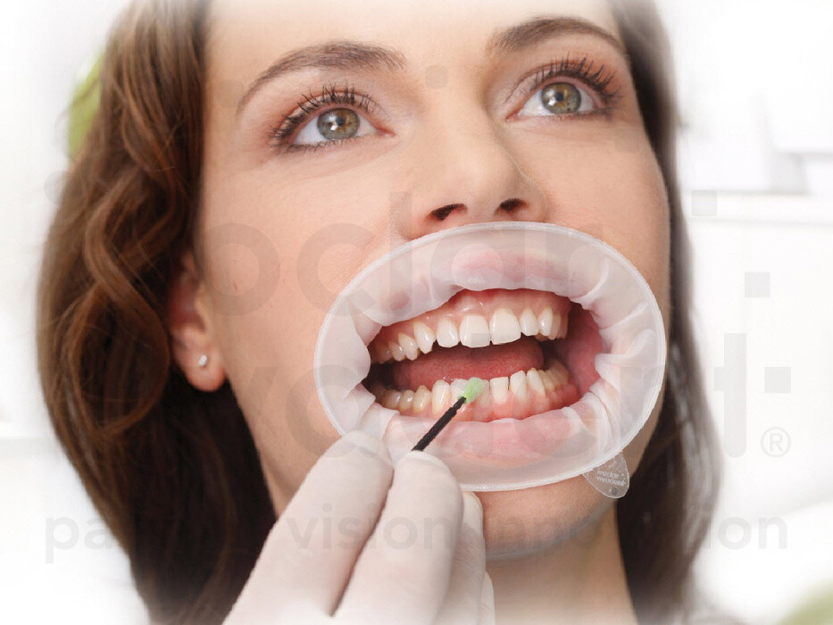 IVOCLAR VIVADENT Optragate Soft Lip Cheek Retractor 8 pc Dental Fast Ship