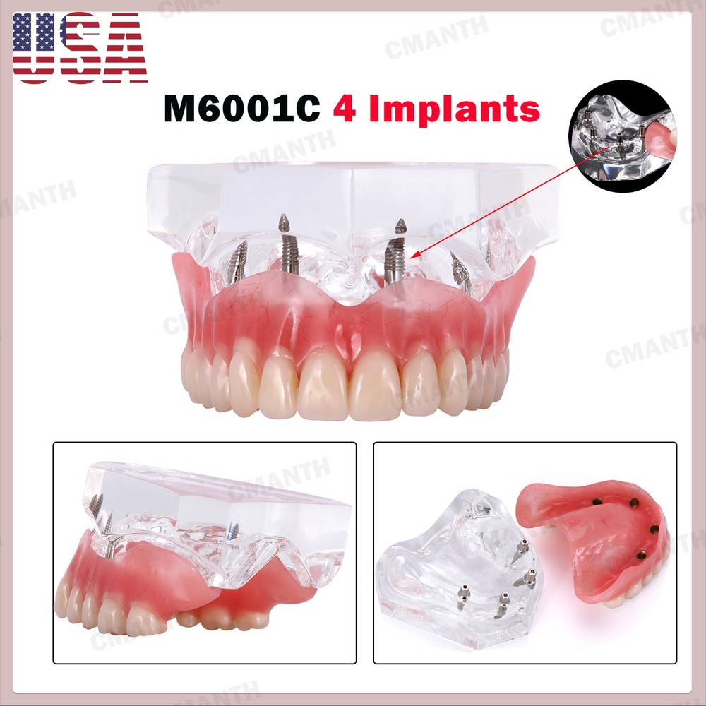 US Dental Model Removable Overdenture Teeth Upper/Lower Jaw 4 Implants Model