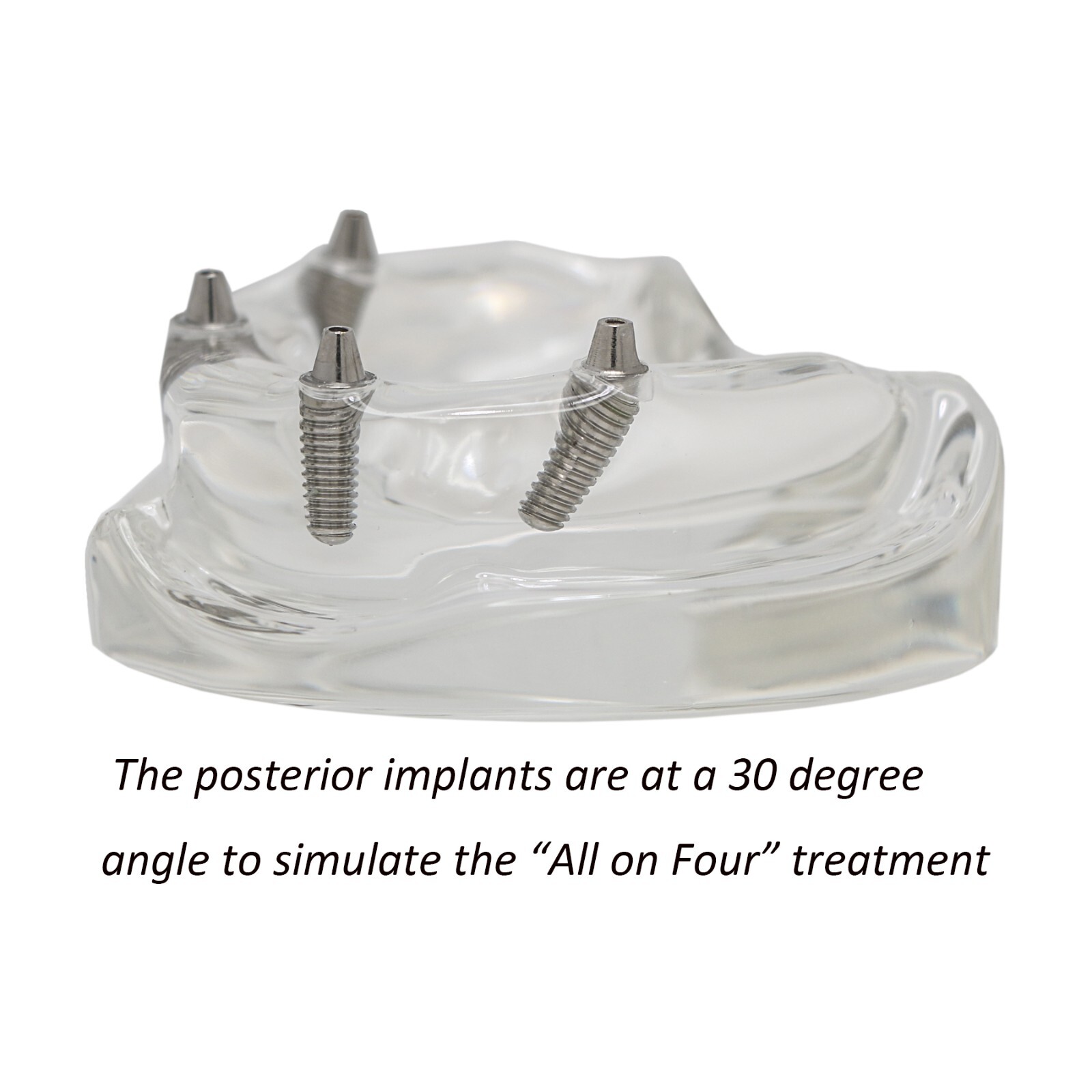 US Dental All-on-4 Overdenture treatment Implant Model Upper 4 Implants Clear