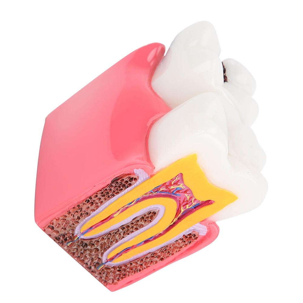 Caries Comparison Study Models Dentist Dental Anatomy Education Teeth Model