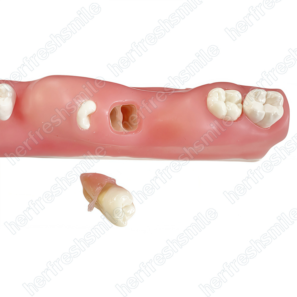Dental Impacted Tooth Model Wisdom Unerupted Tooth Extraction Practice Training