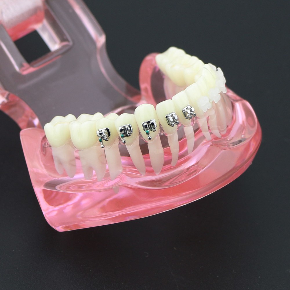 Dental Orthodontic Teeth Model Metal and Ceramic Bracket Study Teach Model 3003