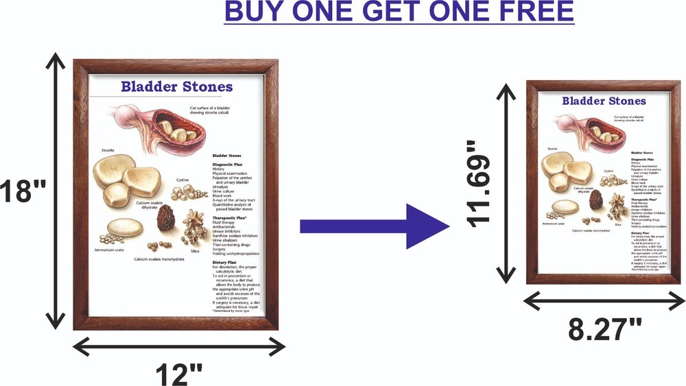 Bladder Stones Chart 12x18 inches