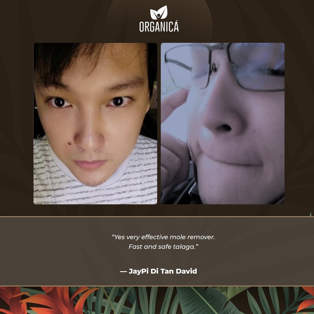 Multi-Awarded Mole and Warts Remover Set