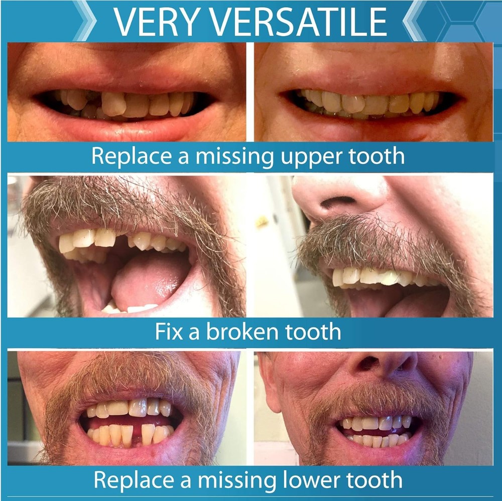Complete Your Smile Tooth Replacement Kit DELUXE PACK - Includes Patented...