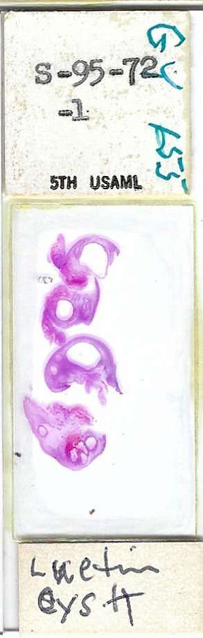 Human Lutein Cyst Pathology Microscope Slide